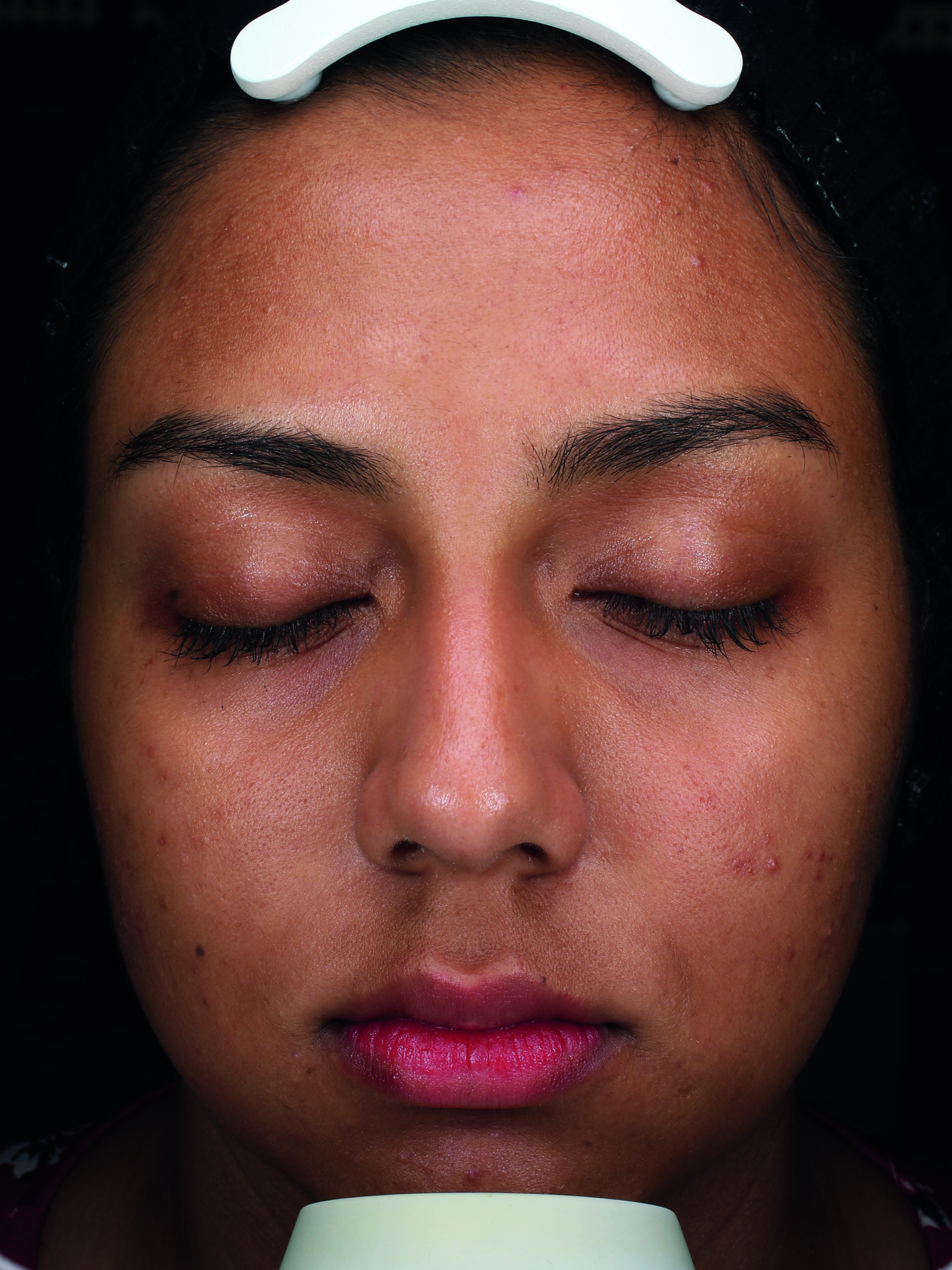 The same skin after the CLEARIST CTX protocol