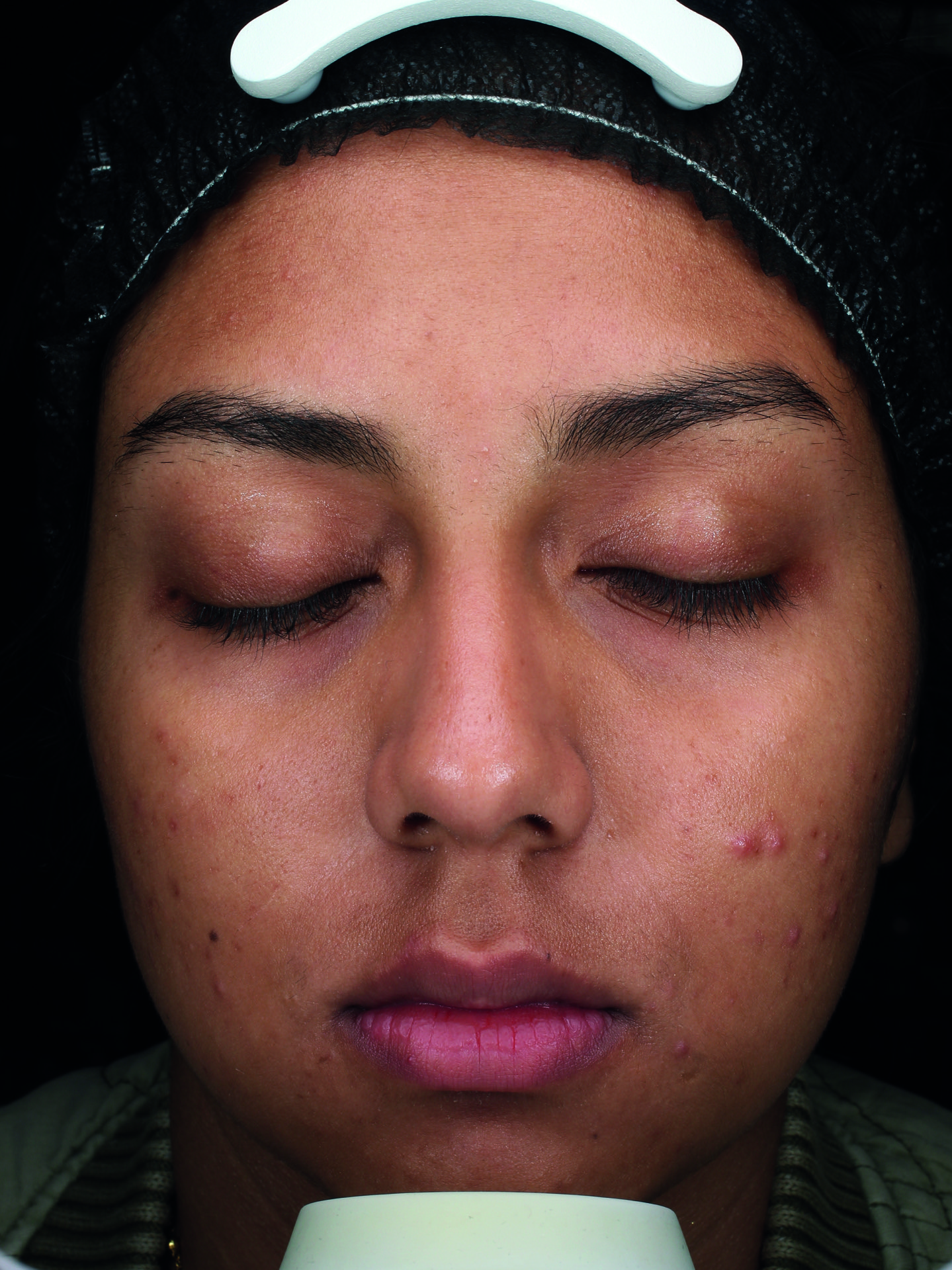 Skin before the CLEARIST CTX protocol